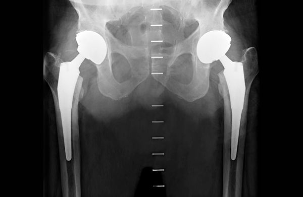 Hip Replacement Isn’t What It Used To Be 12 Weeks Ago